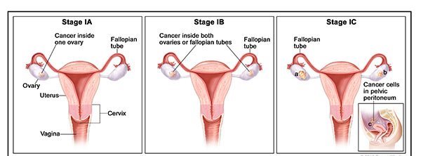 ovarian cancer how to detect